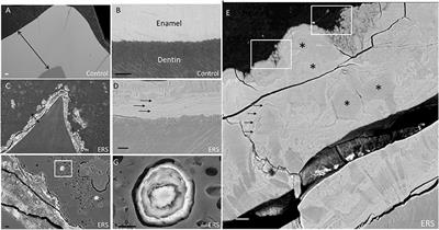 FAM20A Gene Mutation: Amelogenesis or Ectopic Mineralization?